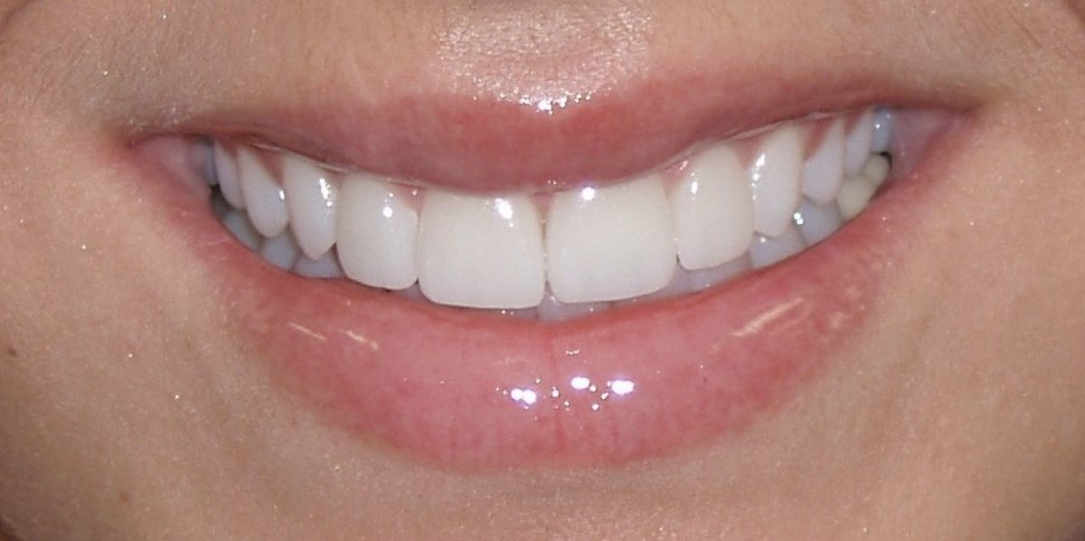 The same patient's smile after treatment, with even edges and a uniform shade