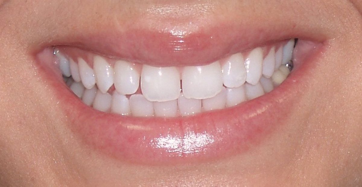 Patient's smile before treatment, with uneven edges and worn front teeth