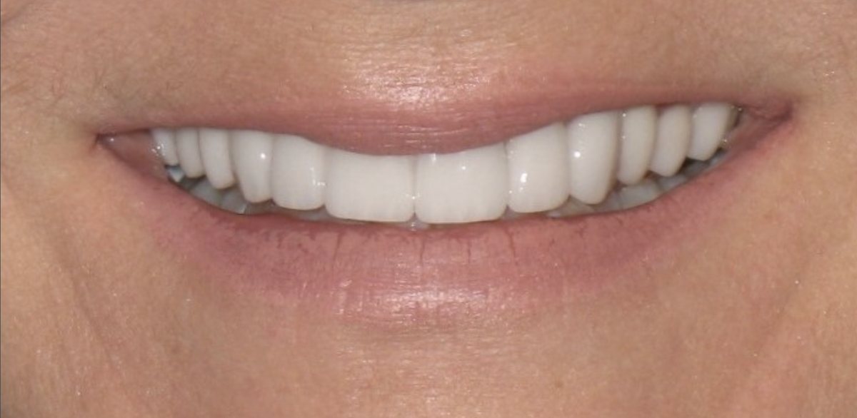 The same patient's smile after treatment, with an even line and uniform shade