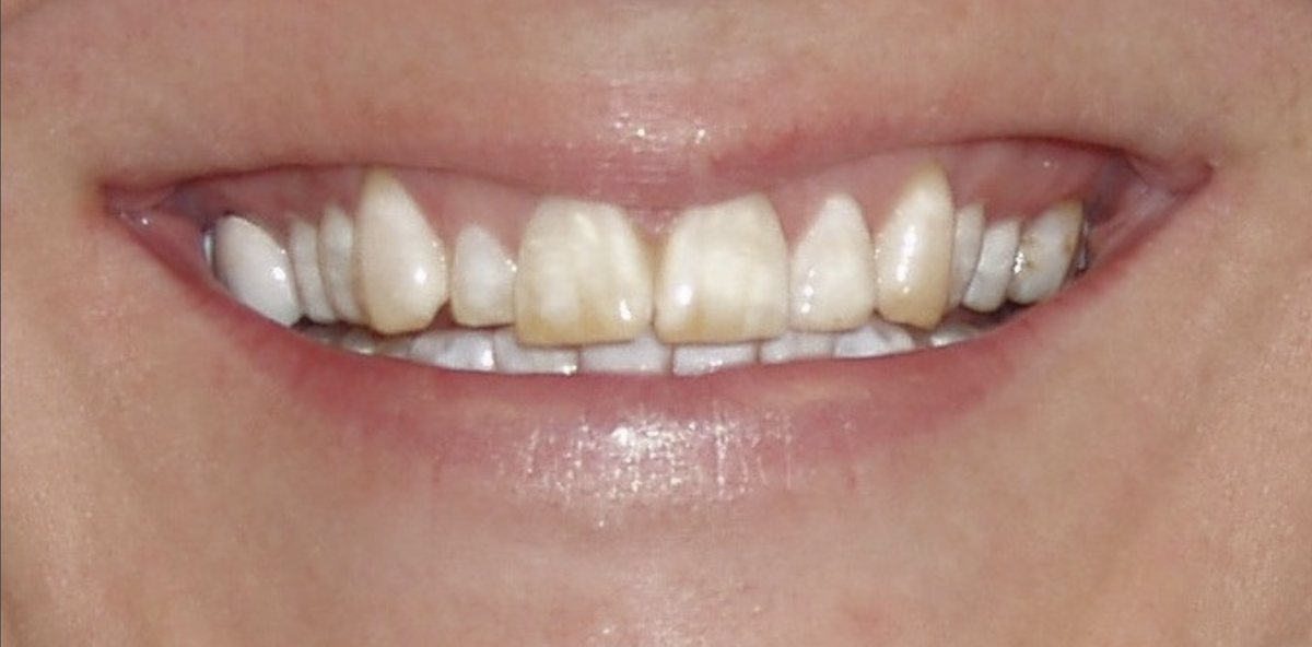 Patient's smile before treatment, with discolored and uneven front teeth